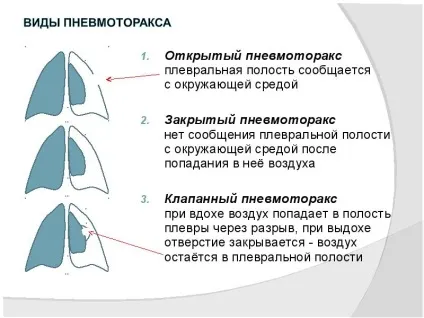 Закритий пневмоторакс симптоми, лікування (лікування) Закритий пневмоторакс симптоми, лікування