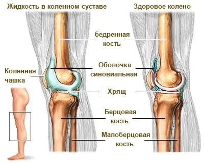 Рідина в колінному суглобі