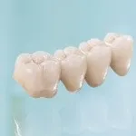 Зубний протез на гачках