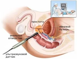 Аденома простати 2 ступеня що таке ДГПЗ, чи потрібна в цьому випадку операція (аденома) Аденома простати 2 ступеня що таке ДГПЗ, чи потрібна в цьому випадку операція