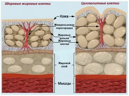 Домашні засоби від целюліту, легко бути красивою! (Домашні) Домашні засоби від целюліту, легко бути красивою!