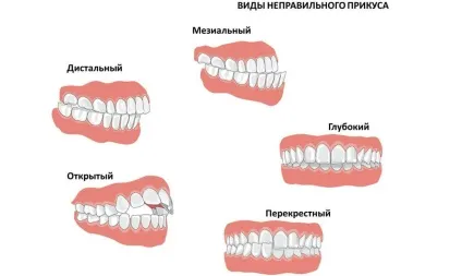Аномалії прикусу - ступінь, профілактика, види (може стати причиною) Аномалії прикусу - ступінь, профілактика, види