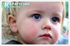 Чим небезпечний діатез, здоров'я дитини (атопічний дерматит може) Чим небезпечний діатез, здоров'я дитини