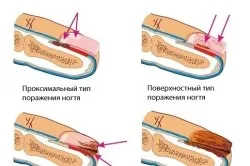 Чим лікувати грибок нігтів у дітей (лікувати) Чим лікувати грибок нігтів у дітей