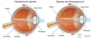 Короткозорість - це мінус або плюс як зрозуміти і чому вона так називається (мінус) Короткозорість - це мінус або плюс як зрозуміти і чому вона так називається