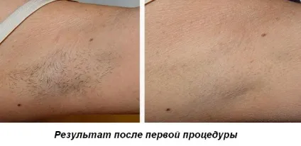 Що робити після першої лазерної епіляції поради та рекомендації (першої) Що робити після першої лазерної епіляції поради та рекомендації