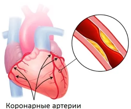 Біль в серці