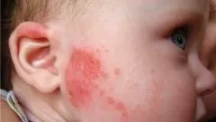 Що таке пітниця - закупорка потових залоз у немовлят - захворювання (висипання шкірні) Що таке пітниця - закупорка потових залоз у немовлят - захворювання