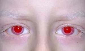 Що таке альбінізм, як він проявляється у людей (альбінізм типи причини лікування) Що таке альбінізм, як він проявляється у людей