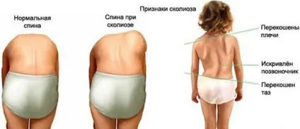 Що таке сколіоз гредного відділу хребта класифікація, види, прояви (хребта) Що таке сколіоз гредного відділу хребта класифікація, види, прояви