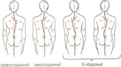 Що таке сколіоз гредного відділу хребта класифікація, види, прояви (хребта) Що таке сколіоз гредного відділу хребта класифікація, види, прояви