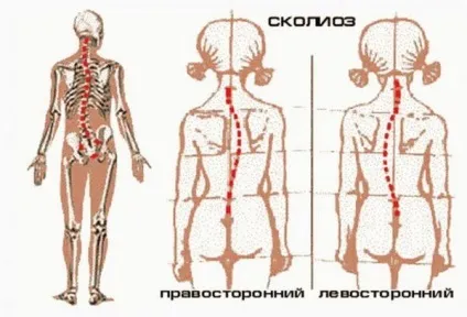 Що таке сколіоз гредного відділу хребта класифікація, види, прояви (сколіоз) Що таке сколіоз гредного відділу хребта класифікація, види, прояви