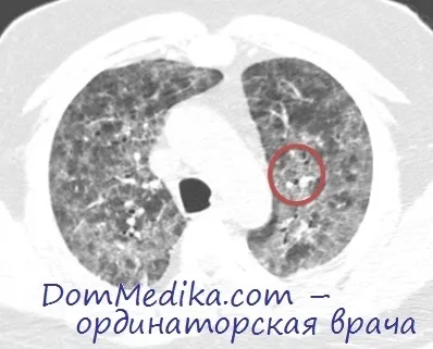 Діагностика запального синдрому відновлення імунітету