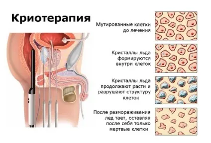Дифузно-вузлова гіперплазія передміхурової залози (гіперплазія) Дифузно-вузлова гіперплазія передміхурової залози