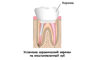 Ендодонтичне лікування кореневих каналів зубів