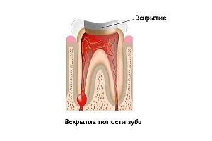 Ендодонтичне лікування кореневих каналів зубів