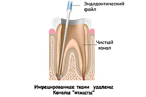 Ендодонтичне лікування кореневих каналів зубів