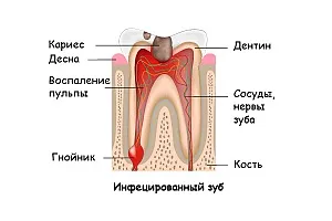 Ендодонтичне лікування кореневих каналів зубів