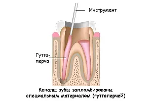 Ендодонтичне лікування кореневих каналів зубів