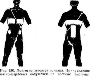 Гіпсова пов'язка - хірургія (бинта) Гіпсова пов'язка - хірургія