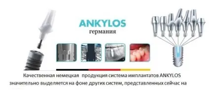 Імпланти ankylos переваги, недоліки та відгуки пацієнтів (ankylos) Імпланти ankylos переваги, недоліки та відгуки пацієнтів