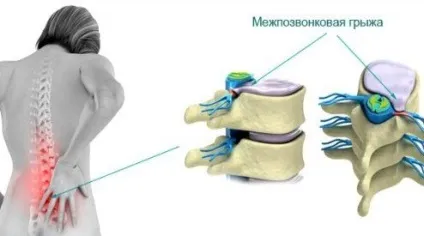 Дорзальная медіанна грижа диска симптоми, лікування (відчуття) Дорзальная медіанна грижа диска симптоми, лікування