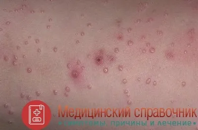 Контагіозний молюск - фото, симптоми, видалення, лікування дітей (лікування) Контагіозний молюск - фото, симптоми, видалення, лікування дітей