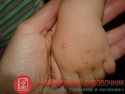 Контагіозний молюск - фото, симптоми, видалення, лікування дітей (контагіозний) Контагіозний молюск - фото, симптоми, видалення, лікування дітей