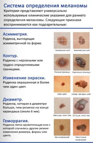 Лікування меланоми можна вилікувати і стан після операції (можна) Лікування меланоми можна вилікувати і стан після операції