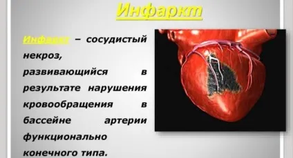Лікування інфаркту міокарда і терапія (міокарда) Лікування інфаркту міокарда і терапія