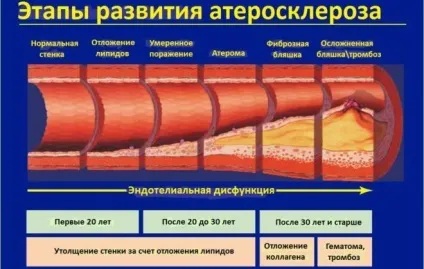 Лікування інфаркту міокарда і терапія (терапія) Лікування інфаркту міокарда і терапія