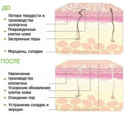 Механічний пілінг особи відгуки, показання, фото до і після, ціни (переваги) Механічний пілінг особи відгуки, показання, фото до і після, ціни