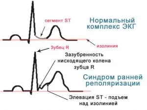 Порушення процесів реполяризації в міокарді (порушення) Порушення процесів реполяризації в міокарді