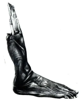 Некроз 1983 ейнгрон а
