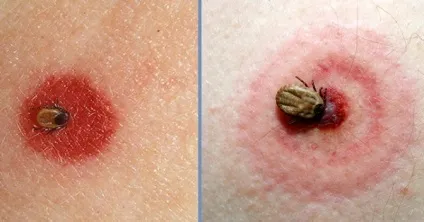 Чи може бути алергія на укус кліща що робити (кліща) Чи може бути алергія на укус кліща що робити
