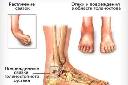 Мрт гомілковостопного суглоба