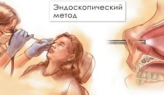 Операційне лікування при гаймориті (операційне) Операційне лікування при гаймориті