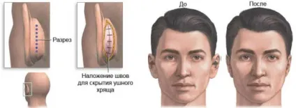 Отопластика в домашніх умовах що потрібно знати (отопластика) Отопластика в домашніх умовах що потрібно знати