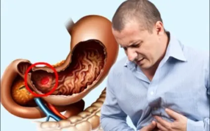 Ускладнення цирозу печінки