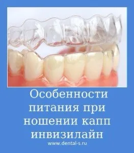 Елайнери Инвизилайн (invisalign) ціна на капи Київ (Инвизилайн Київ) Елайнери Инвизилайн (invisalign) ціна на капи Київ