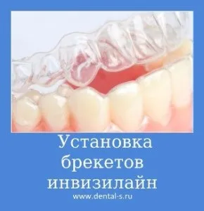 Елайнери Инвизилайн (invisalign) ціна на капи Київ (ціна) Елайнери Инвизилайн (invisalign) ціна на капи Київ