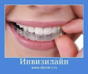 Елайнери Инвизилайн (invisalign) ціна на капи Київ (капи) Елайнери Инвизилайн (invisalign) ціна на капи Київ