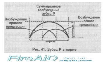 Електрокардіографічні (ЕКГ) ознаки гіпертрофії міокарда (ЕКГ) Електрокардіографічні (ЕКГ) ознаки гіпертрофії міокарда