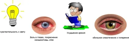 Ерозія рогівки ока причини, симптоми, лікування і ускладнення (очі) Ерозія рогівки ока причини, симптоми, лікування і ускладнення
