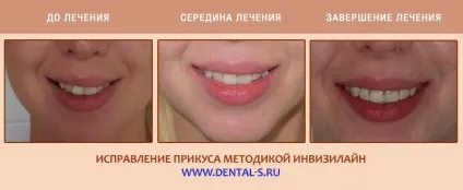 Елайнери Инвизилайн (invisalign) ціна на капи Київ (елайнери) Елайнери Инвизилайн (invisalign) ціна на капи Київ