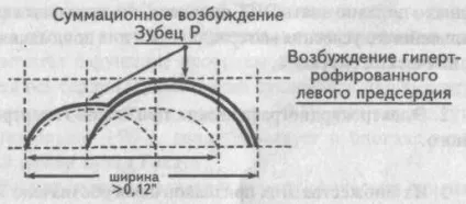 Електрокардіографічні ознаки гіпертрофії міокарда - кардіолог - сайт про захворювання серця і