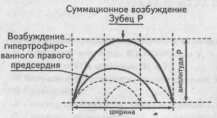 Електрокардіографічні ознаки гіпертрофії міокарда - кардіолог - сайт про захворювання серця і
