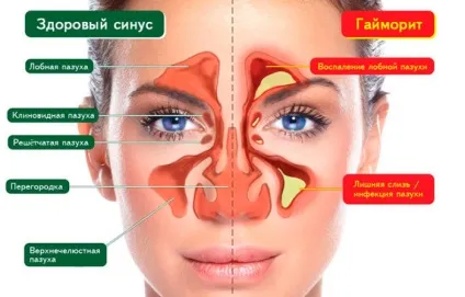 Ексудативний гайморит симптоми і лікування народними методами
