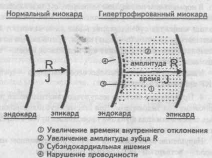 Електрокардіографічні ознаки гіпертрофії міокарда - кардіолог - сайт про захворювання серця і
