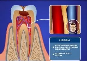 Чому зуб болить тільки вночі (болить) Чому зуб болить тільки вночі